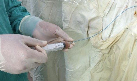 Hình 2 10 Đặt ống thông niệu quản lên phía trên tắc nghẽn để lấy nước 2