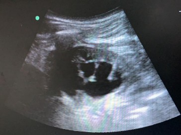 Hình 2 16 Siêu âm chọn vị trí vào đài thận Nguồn chụp tại Bệnh Viện 5