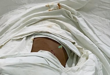 Hình 2 17 Nước tiểu chảy ra từ hệ thống đài bể thận Nguồn chụp tại 6