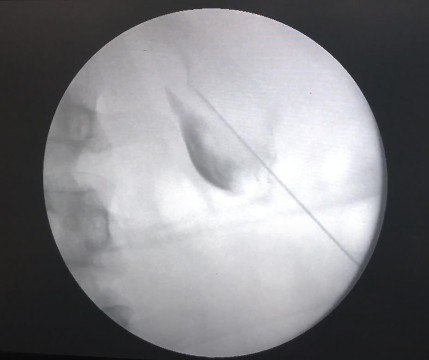 Hình 2 19 Bơm thuốc cản quang vào hệ thống đài bể thận Nguồn chụp tại 8