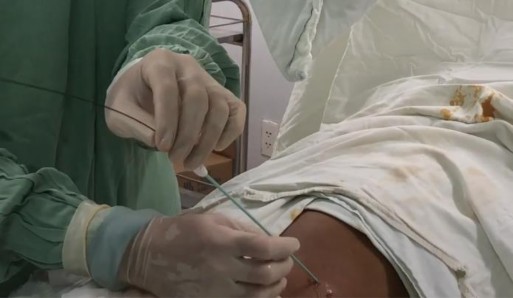 Hình 2 20 Luồn dây dẫn ái nước vào hệ thống đài bể thận Nguồn chụp 9