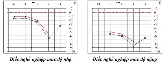 Hình 1 3 Tiến triển của giảm thính lực do tiếng ồn Trên thính lực đồ 2