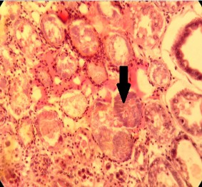Hình 3 5 Tổ chức mô của tôm bị AHPND Mũi tên đen Các tế bào máu tập hợp 2