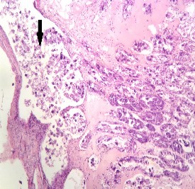 Hình 3 5 Tổ chức mô của tôm bị AHPND Mũi tên đen Các tế bào máu tập hợp 3