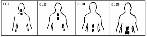 Hình 1 13 Bốn vị trí đặt điện cực của Traberrt EL Electrode Localisation 2