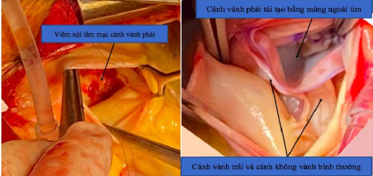Hình 4 10 Viêm nội tâm mạc nhiễm khuẩn cánh vành phải bên phải cánh vành 1