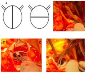 Hình 4 12 A B Tái tạo van ĐMC hai cánh van nhóm 0 C D Đo kích thước hai cánh van 3