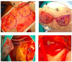 Hình 4 12 A B Tái tạo van ĐMC hai cánh van nhóm 0 C D Đo kích thước hai cánh van 4
