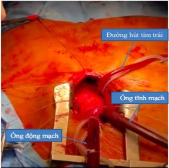 Hình 1 Phẫu thuật tái tạo van động mạch chủ bằng màng ngoài tim tự thân qua 1