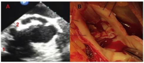 Hình 2 A Hình ảnh trên siêu âm tim qua thành ngực 1 ổ aps xe vòng van ĐMC 2 2