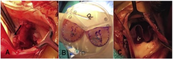 Hình 3 A vá ổ áp xe vòng van ĐMC bằng miếng vá màng ngoài tim tự thân B Hai 3