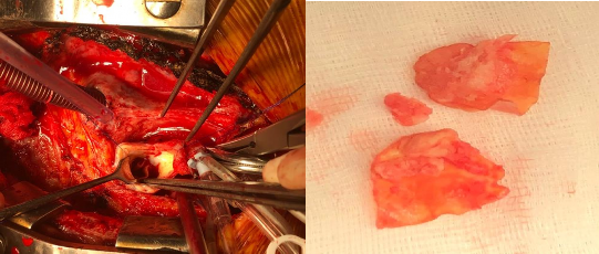 Hình 4 Viêm nội tâm mạc nhiễm khuẩn van động mạch chủ tái tạo bằng màng 4