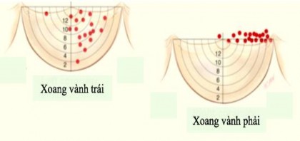 Hình 1 7 Sơ đồ vị trí xuất phát hai lỗ động mạch vành Nguồn Anderson 7
