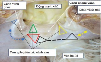 Hình 1 8 Lược đồ các tam giác giữa các cánh van động mạch chủ Nguồn 8