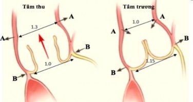 Hình 1 9 Tương quan tỷ lệ đường kính vòng van động mạch chủ và chỗ nối 1