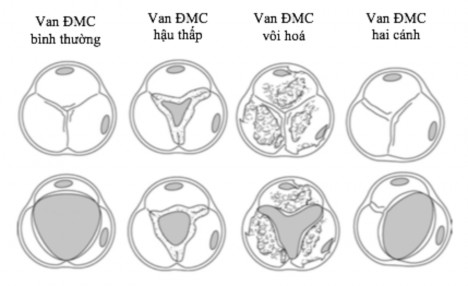Hình 1 14 Hình thái thương tổn giải phẫu van động mạch chủ Nguồn 1
