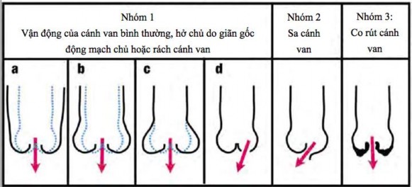 Hình 1 15 Các cơ chế hở van động mạch chủ theo phân loại Carpentier Nguồn 2