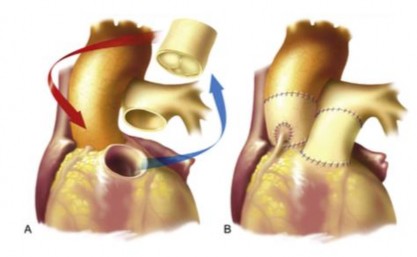 Hình 1 17 Phương Pháp Ross Chuyển vị gốc động mạch phổi thay cho gốc động 4