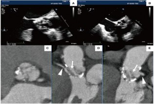 Hình 1 22 Hình ảnh siêu âm tim A B và chụp cắt lớp vi tính của bệnh nhân sau 3