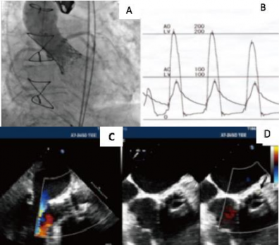 Hình 1 23 Hình ảnh thay van động mạch chủ qua đường ống thông A B và kết 4