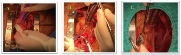 Hình 2 9 A Đánh dấu vị trí mở động mạchc hủ B Cắt bỏ van ĐMC và lấy 1