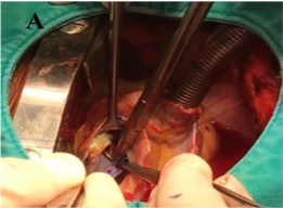 Hình 2 11 Khâu các cánh van bằng màng ngoài tim vào vòng van động mạch chủ 3