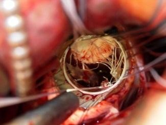 Hình 4 3 Dụng cụ bộc lộ cơ nhú của tác giả Lamelas 60 Nguồn 2