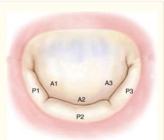 Hình 1 2 Phân vùng van hai lá theo Carpentier Nguồn Carpentier A 2010 24 Sự phân 1