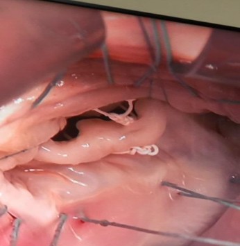 Hình sửa van hai lá sử dụng dây chằng nhân tạo BN Nguyễn K – 55 tuổi Xác 21