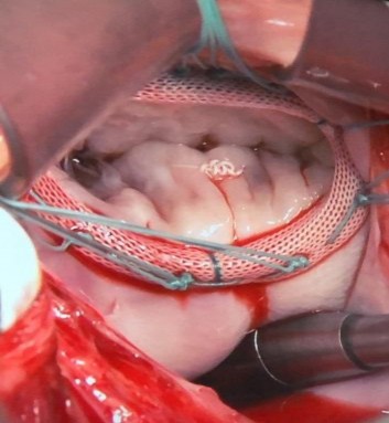 Hình sửa van hai lá sử dụng dây chằng nhân tạo BN Nguyễn K – 55 tuổi Xác 22