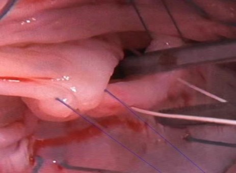 Xác định kích thước chuẩn trong kỹ thuật gắn dây chằng nhân tạo BN Lý 23