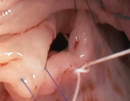 Xác định kích thước chuẩn trong kỹ thuật gắn dây chằng nhân tạo BN Lý 24