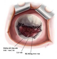 Hình 1 5 Van hai lá nhìn từ nhĩ trái Nguồn Carpentier A 2010 24 Vùng tiếp nối 1