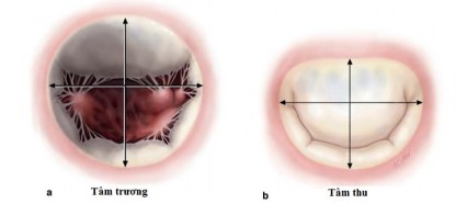 Hình 1 6 Sự thay đổi của hình dạng vòng van hai lá trong chu chuyển tim Nguồn 2