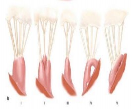 Hình 1 10 Các dạng trụ cơ Nguồn Carpentier A 2010 24 Trụ cơ van hai lá liên 6