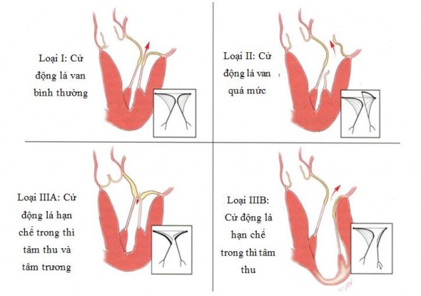 Hình 1 11 Phân loại hở van hai lá theo Carpentier Nguồn Carpentier A 2010 24 Cách 7