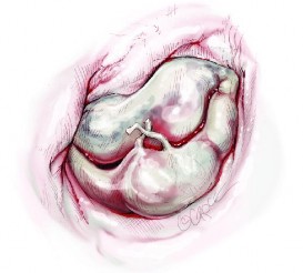 Hình 1 12 Đứt dây chằng van hai lá Nguồn TohruAsai Jul 17 2015 Hình 1 13 Dãn 1