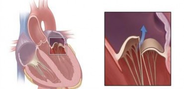 Hình 1 13 Dãn dài dây chằng van hai lá Nguồn Clin Res Cardiol May 17 2018 Vùng áp 2