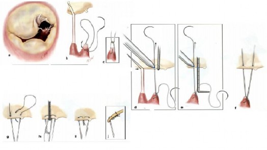 Hình 1 16 Kỹ thuật hiệu chỉnh độ dài dây chằng nhân tạo ở lá van Nguồn 1