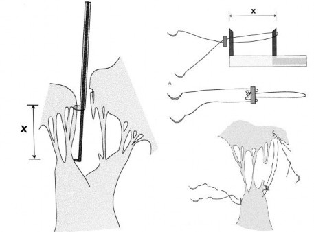 Hình 1 17 Kỹ thuật hiệu chỉnh chiều dài dây chằng nhân tạo của Von Oppell và 2