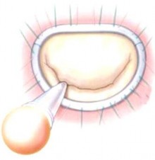 Hình 1 18 Bơm nước vào thất trái và kiểm tra vùng áp của van hai lá Nguồn 3