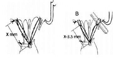 Hình 1 19 Dây chằng kiểu vòng lặp của tác giả Shigehiko Tokunaga Nguồn 1