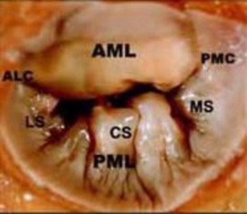 Hình 2 1 Bệnh lý hở van hai lá trên siêu âm 4D Hình 2 2 Siêu âm hở van 2 lá 3