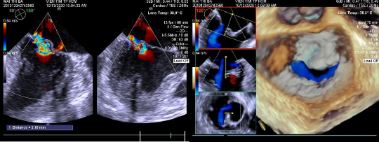 Hình 2 2 Siêu âm hở van 2 lá Doppler màu và 4D 2 2 3 2 Chỉ định phẫu thuật 4