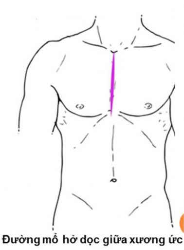 Hình 2 4 Mở ngực đường giữa Phẫu thuật tim hở với sự trợ giúp của máy 6