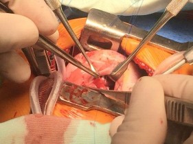 Hình 2 11 Kĩ thuật bộc lộ lỗ thông liên thất bằng miếng vá màng ngoài tim 1