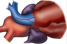 Hình 2 12 Kĩ thuật mở rộng thân và gốc ĐMP Nguồn Van A l 2014 111  Nếu 2