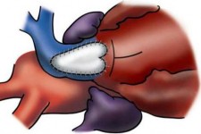 Hình 2 12 Kĩ thuật mở rộng thân và gốc ĐMP Nguồn Van A l 2014 111  Nếu 3