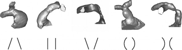 Hình 4 1 Các kiểu hình thái đường thoát thất phải sau mổ Nguồn Schievano 1