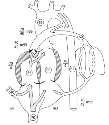 Hình 1 5 Sinh lý bệnh học tứ chứng Fallot trong giai đoạn bào thai Nguồn Rudolph 1